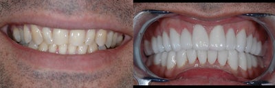 Smile Makeover before and after photo