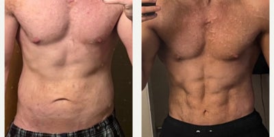 Abdominal Etching before and after photo