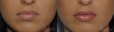 Lip Fillers before and after photo