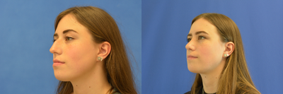 Rhinoplasty before and after photo