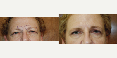 Eyelid Surgery before and after photo