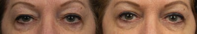Eyelid Surgery before and after photo