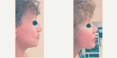 Rhinoplasty before and after photo