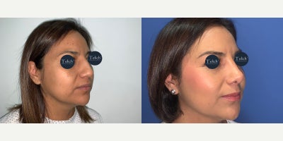 Rhinoplasty before and after photo
