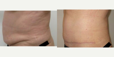 Tummy Tuck before and after photo
