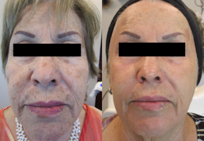 CO2 Laser before and after photo