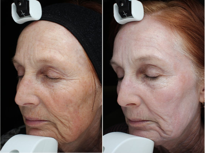 Fraxel Laser before and after photo
