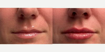 Lip Fillers before and after photo