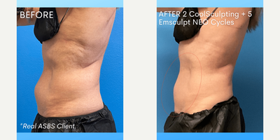 Emsculpt before and after photo