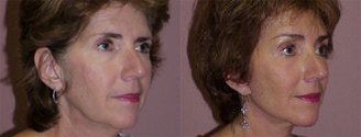 Facelift before and after photo