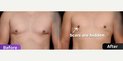 Gynecomastia Surgery before and after photo