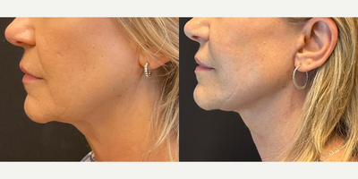 Neck Lift before and after photo