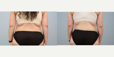 Tummy Tuck before and after photo