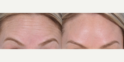Botox before and after photo