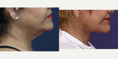 Chin Liposuction before and after photo