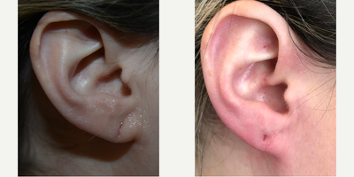 Earlobe Repair before and after photo