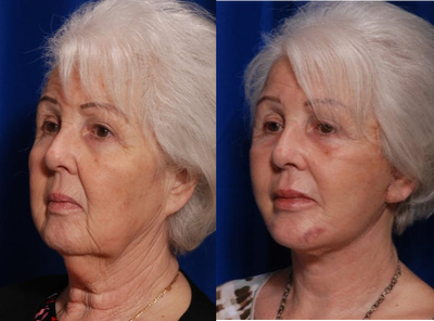 Facelift before and after photo