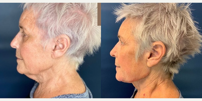 Kybella before and after photo