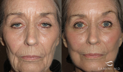 Ptosis Surgery before and after photo