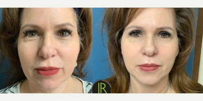 Facelift before and after photo