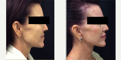 Facial before and after photo