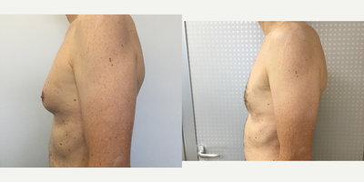 Gynecomastia Surgery before and after photo