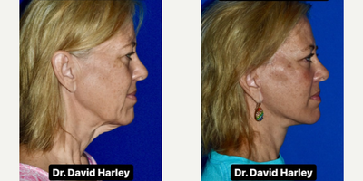 Neck Lift before and after photo