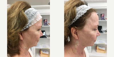 Thread Lift before and after photo