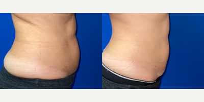 truSculpt before and after photo