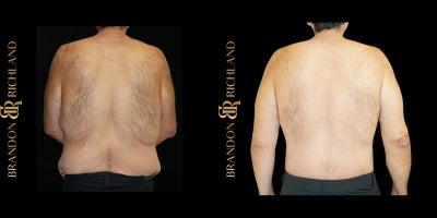 Body Lift before and after photo