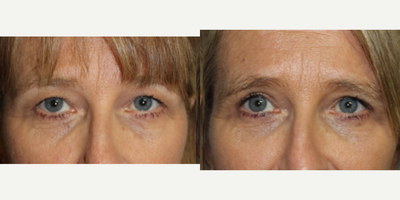 Eyelid Surgery before and after photo