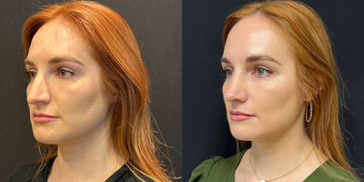 Rhinoplasty before and after photo