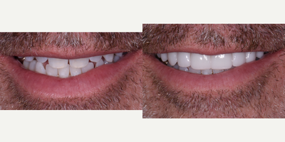 Smile Makeover before and after photo