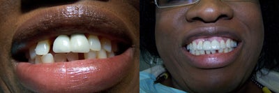 Smile Makeover before and after photo