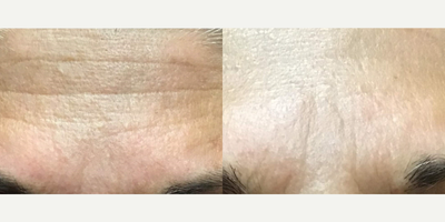 Botox before and after photo