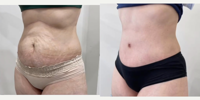 Drainless Tummy Tuck before and after photo