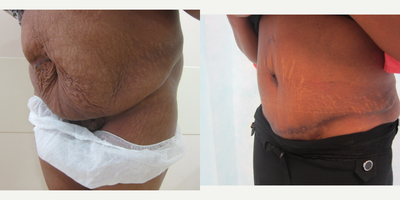 Tummy Tuck before and after photo
