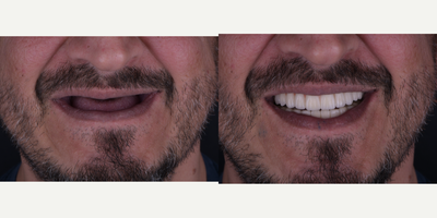 All-on-4 Dental Implants before and after photo