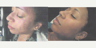 Clear and Brilliant before and after photo