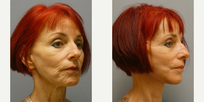 Deep Plane Facelift before and after photo
