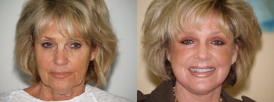 Facelift before and after photo