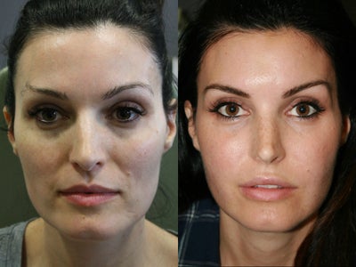 Facial Fat Transfer before and after photo