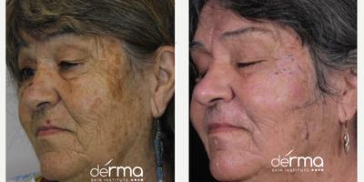 Laser Resurfacing before and after photo