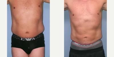 Liposculpture before and after photo