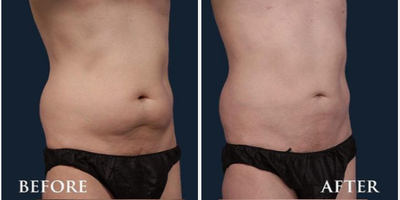 Liposuction before and after photo