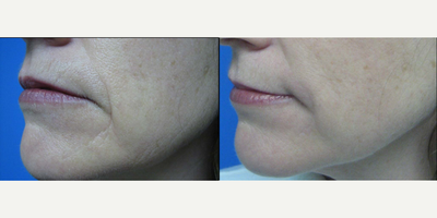 Restylane before and after photo
