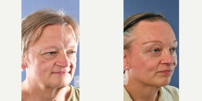 Rhinoplasty before and after photo