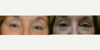 Eyelid Surgery before and after photo