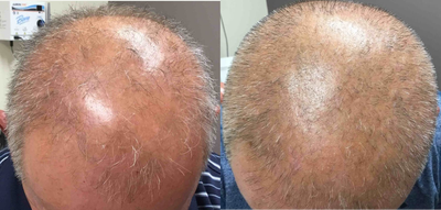 PRP Injections before and after photo