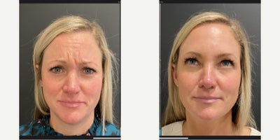 Botox before and after photo